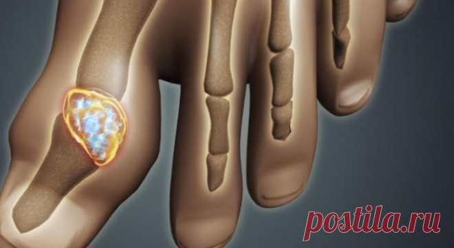 Причины, симптомы, лечение подагры / Будьте здоровы