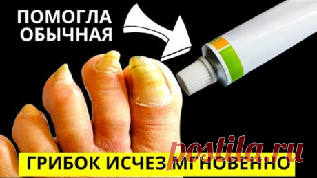 Эта ЯДРЁНАЯ Советская Мазь Разъест Весь Грибок с Ногтей! Есть в Любой Аптеке!