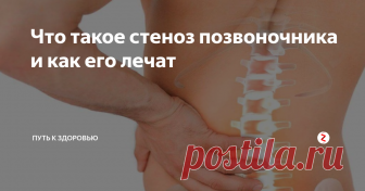 Что такое стеноз позвоночника и как его лечат С возрастом у многих  людей наблюдается сужение позвоночного канала, расположенного в нижней  области спины. Впоследствии это приводит к стенозу (сужению)  позвоночника. В результате такого явления уменьшается пространство, где  проходит спинной мозг и нервы.
Причины
Стеноз спинальный  возникает, когда выпуклые позвоночные диски, артритные шпоры и  утолщенные ткани объединяются, вследствие чего не