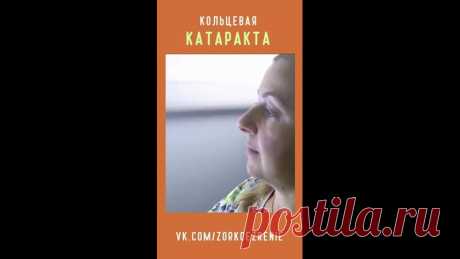 Что такое Кольцевая катаракта? Катаракта — это заболевание, при котором хрусталик глаза поглощает больше света, чем он может произвести.
В результате он становится мутным по круговому периметру(кольцу) и не может доставлять свет в глаз.
Это приводит к снижению зрения.
Катарактой называют и любое помутнение хрусталика, независимо от
Показать ещё