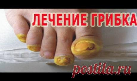 Лечение ГРИБКА НОГТЕЙ народными методами. 9 лучших рецептов против МИКОЗА. — Копилочка полезных советов