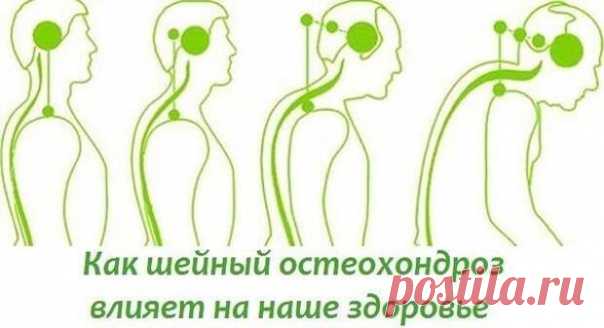 БОЛИТ ШЕЯ? КАК ШЕЙНЫЙ ОСТЕОХОНДРОЗ ВЛИЯЕТ НА НАШЕ СОСТОЯНИЕ...