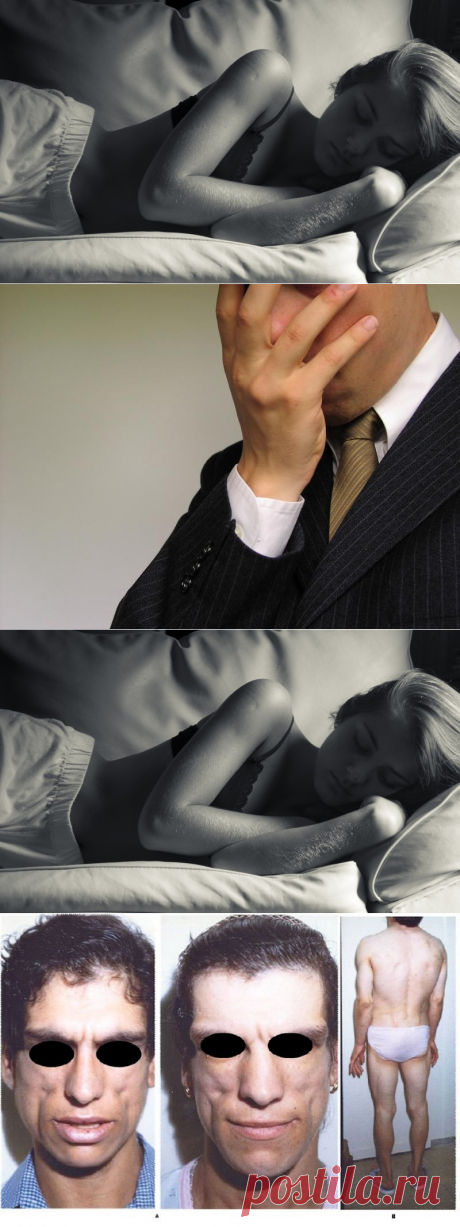 25 самых странных болезней мира, которые ученые до сих пор не могут объяснить