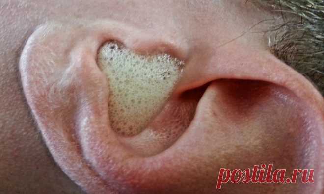 Бурлящими потоками вся грязь изыйдет: избавляемся от ушной серы с помощью перекиси водорода - HeadInsider - Новости Здоровья