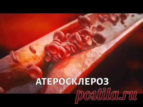 Доктор БОКЕРИЯ. Кому грозит атеросклероз?