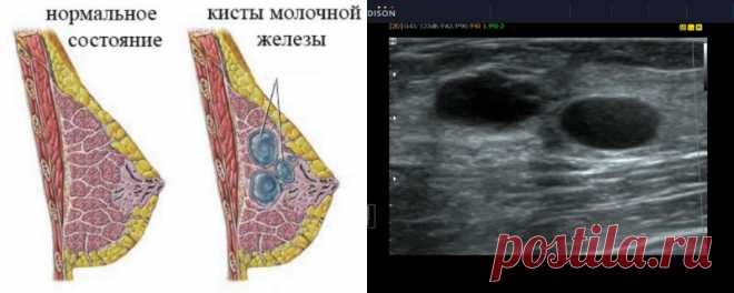 Как вылечить кисту