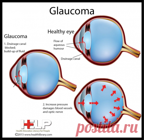 Glaucoma