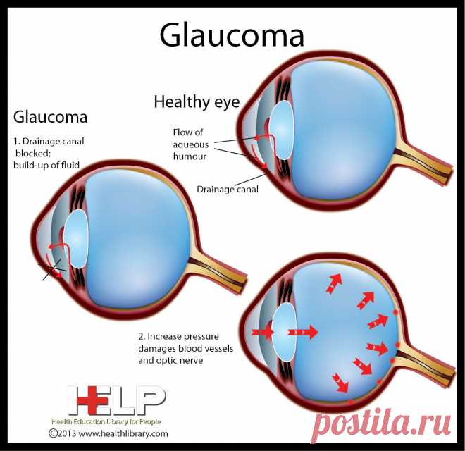 Glaucoma