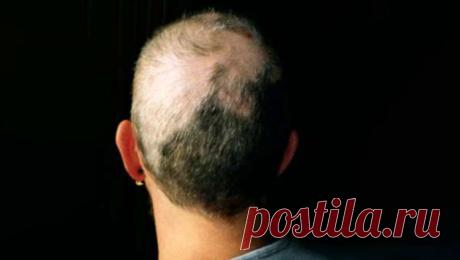 Россияне стали чаще рвать на себе волосы. Число россиян, страдающих трихотилломанией — психическим расстройством, при котором человек выдергивает у себя волосы, — за последнее время увеличилось в 1,5–2 раза. Об этом сообщает Telegram-канал Baza. По информации ...