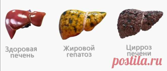 Устраняю жировой гепатоз (ожирение печени) за 10-дневный курс. Ушел живот, уменьшились отеки, посвежела кожа | Пампушка на сушке | Дзен