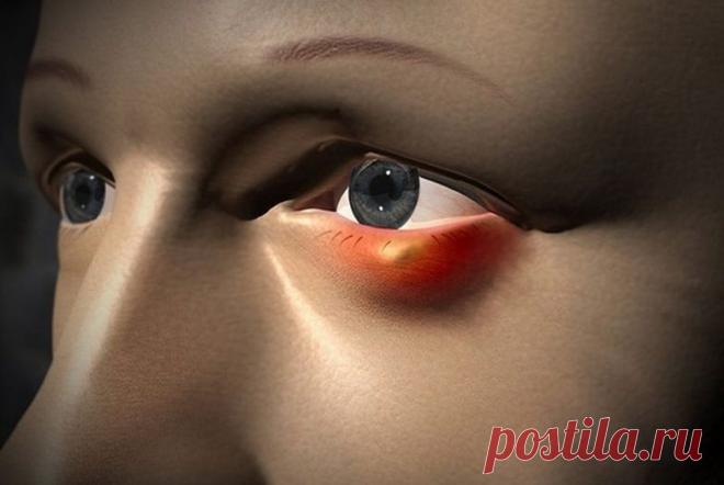 Для точного определения причины образования ячменя обращайтесь к офтальмологу. Он сможет назначить правильное лечение после диагностических процедур.