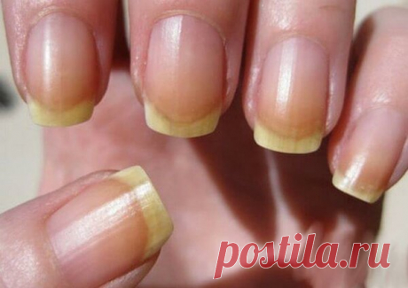 7 состояний ваших ногтей, которые могут сказать о неполадках в организме | На каблуке | Яндекс Дзен