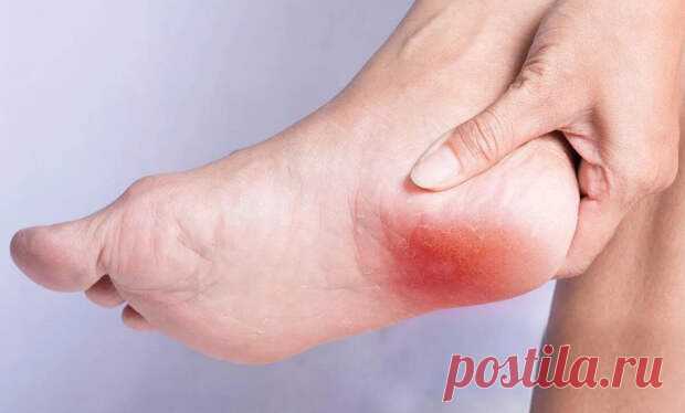 Когда шпора - не шпора - ПолонСил.ру - социальная сеть здоровья - Медиаплатформа МирТесен Вряд ли кто-то никогда не слышал о пяточной шпоре. Пусть не у себя, а у других. При этом вряд ли все, кто о шпоре слышал, знают, что это такое - помимо боли в пятке. Сам термин «шпора»происходит от того, что мы зачастую видим на рентгенограмме стопы. Красной стрелкой показан костный выступ на - 19 декабря - 43771691015 - Медиаплатформа МирТесен