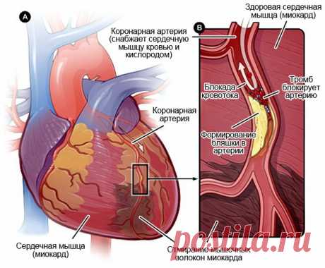 От чего образуются тромбы в сосудах: 3 основные причины