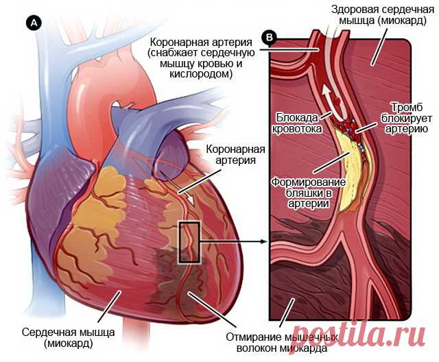 От чего образуются тромбы в сосудах: 3 основные причины