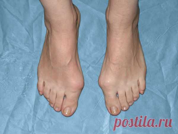 Лечение Вальгусной деформации