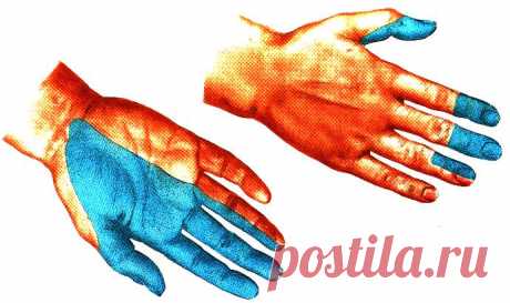 Невропатия лучевого нерва: симптомы и лечение