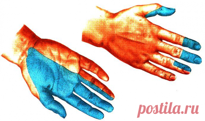 Невропатия лучевого нерва: симптомы и лечение