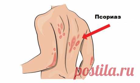 Домашние средства для псориаза Эти средства лучше любых лекарств! Псориаз является раздражающим и хроническим расстройством кожи, характеризующимся покраснением и раздражением, и часто