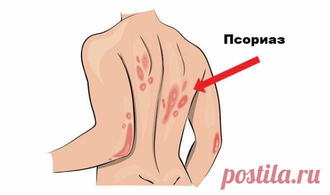 Домашние средства для псориаза Эти средства лучше любых лекарств! Псориаз является раздражающим и хроническим расстройством кожи, характеризующимся покраснением и раздражением, и часто