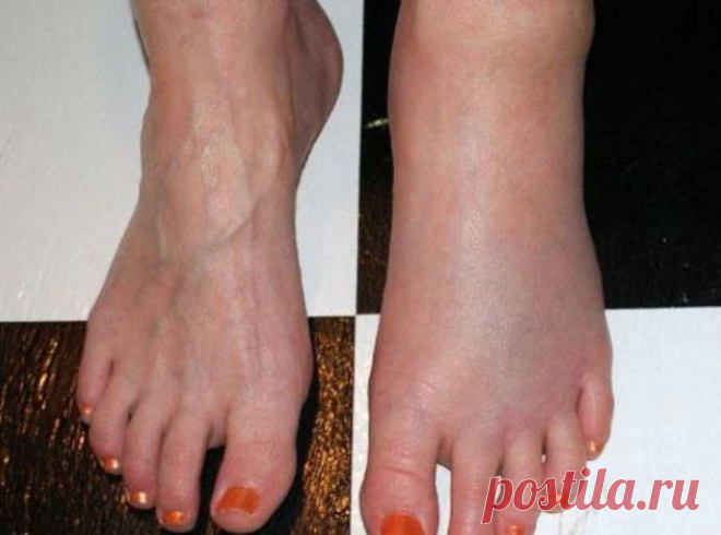 Семена льна от отеков ног: 8 простых рецептов снять отечность с ног. Простое лечение без таблеток - Образованная Сова