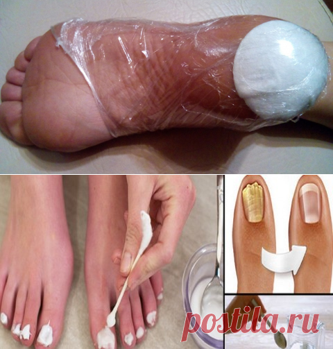 Это средство избавить от трещин и мозолей на пятках всего за 10 дней