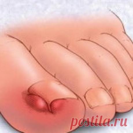 БЕЗБОЛЕЗНЕННОЕ ЛЕЧЕНИЕ ВРОСШЕГО НОГТЯ В ДОМАШНИХ УСЛОВИЯ.