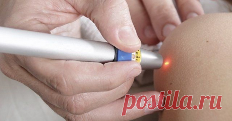 Удаление папиллом лазером: последствия и сколько стоит процедура