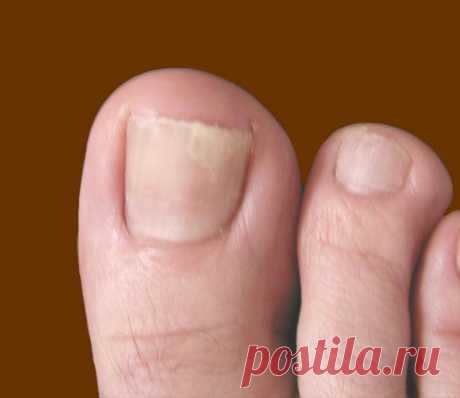 lechenie nail fungus
