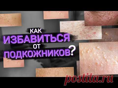 Подкожники. Что такое и как от них избавиться?