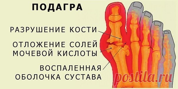 ЕСЛИ ЗАМУЧИЛА ПОДАГРА

Подагра – это такая серьезная болезнь, которая способна сломить даже очень сильного человека. Боли, которые она «приводит» с собой, просто невыносимые. Да еще и «атаки» свои любят проводить эти боли в ночное время. Кто ж тут выдержит! Болезнь серьезная, но подагра лечится, нужно просто тоже к ней отнестись с полной серьезностью. Хочу предложить вам советы и рецепты народной медицины. С их помощью вы сможете дать достойный отпор подагре с ее нестерпим...