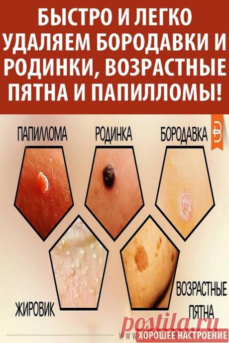 Многих интересует, как вывести бородавку быстро и безболезненно. Справиться с этим кожным недугом необходимо, поскольку по прошествии некоторого времени он доставит массу неудобств своим носителям, губя не только здоровье, но и внешний облик человека. Для начала необходимо изучить и понять, что такое бородавка, как с ней можно и нужно бороться.