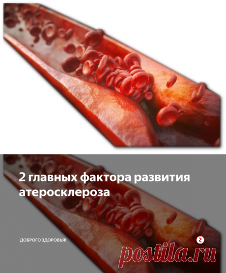 2 главных фактора развития атеросклероза | Доброго здоровья! | Яндекс Дзен