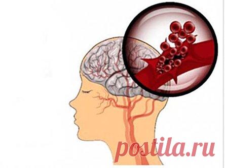 Предупреждающие знаки инсульта, которые вы должны знать и следить за ними!