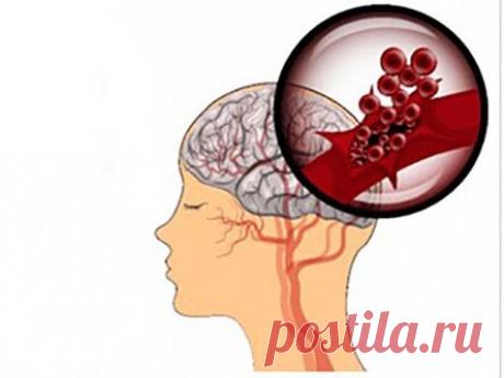 Предупреждающие знаки инсульта, которые вы должны знать и следить за ними!