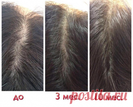 Пантовигар для волос: отзывы, цена, для роста, от выпадения, состав, аналоги, витамины, фото до и после, противопоказания, показания, и ногтей, инструкция, сколько стоит