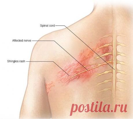 Опоясывающий герпес (опоясывающий лишай): причины, симптомы и лечение в статье инфекциониста Александров П. А. Опоясывающий герпес - это не инфекционное заболевание, а одна из разновидностей реактивации вируса ветряной оспы.
Проявляется опоясывающий герпес тем же симптомом, что и ветрянка, только более выраженными болями.
Но эти боли имеют свою особенность - они появляются по ходу нервов.
Вирус, вызывающий опоясывающий лишай, не передается бытовым или иным путем.
Он остается навсегда в организ…