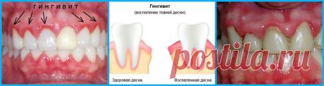 Лечение десен народными средствами: рецепты настоев, отваров