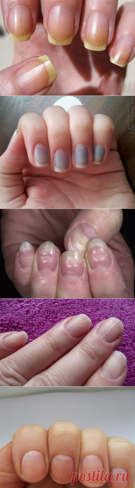 Диагностика здоровья по состоянию ногтей / Будьте здоровы
