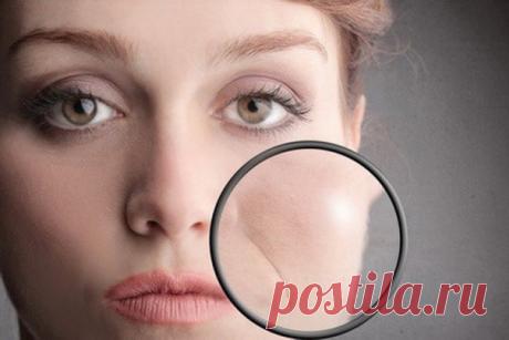 КАК ИЗБАВИТЬСЯ ОТ НОСОГУБНЫХ СКЛАДОК

Носогубные складки рано или поздно появляются у каждой женщины. Хотим мы этого или нет, но они неизбежны. Вещь это довольно неприятная: мимические морщины придают лицу уставший вид, зрительно старят его и выглядят не эстетично.