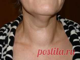 Лечение зоба народными средствами.