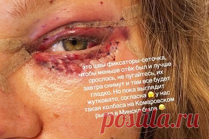 Рита Дакота показала лицо со швами после новой пластики