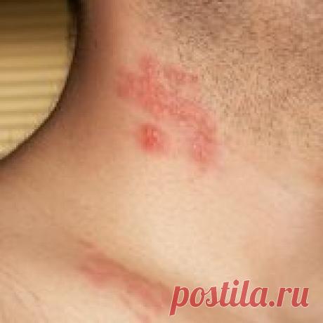 Народные методы лечения опоясывающего лишая