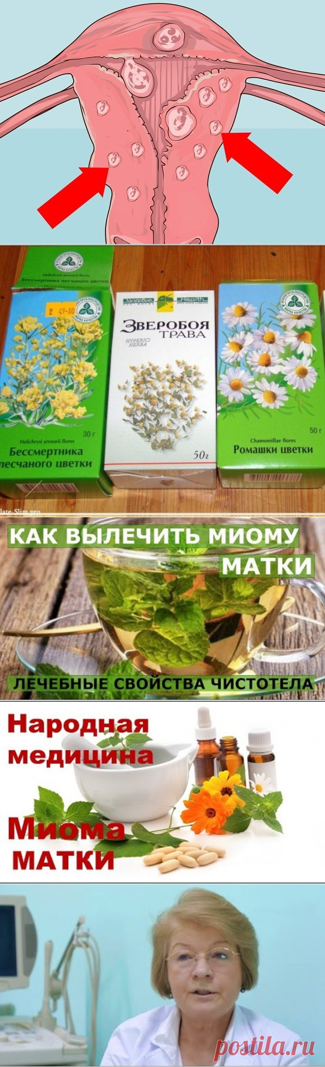 Вот рецепт:
Пустырник 3 г
Боярышник 2 г (ягоды)
Зверобой 2 г
Ромашка 1 г
Календула 1 г
Кора крушины 1 г
Бессмертник 3 г
С вечера эту смесь трав залить кипятком 450 мл в термосе и настаивать ночь. Пить по 100 г 2 раза в день за час до еды 3 месяца.
Я пила 4 месяца по 200 г 2 раза в день — утром и вечером. Исчезла миома.