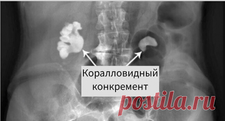 «Размеры камней в почках: что делать при различных конкрементах. Размеры камней в почках варьируются от нескольких миллиметров до нескольких сантиметров, от размера и состава камней зависит выбор лечения. Для медицинского растворения используют такие препараты: Но не всегда при помощи профилактики можно предупредить появление болезни, особенно если у больного в почках уже есть конкременты больших размеров. Что делать, как лечить камни при небольших...