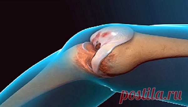 Врачи поражены: Этот рецепт возобновляет работу коленей и суставов! — Домашние заботы