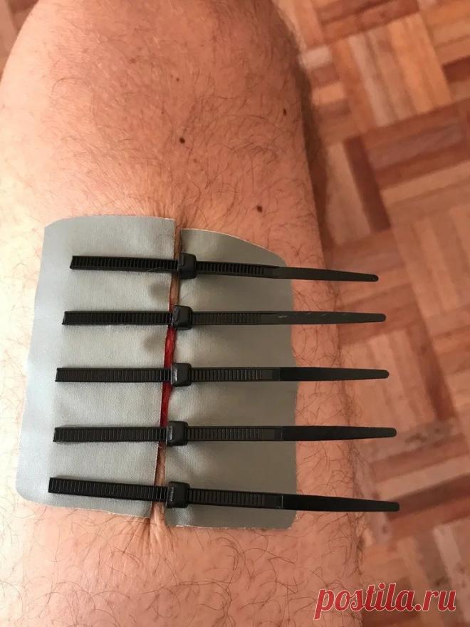 Приспособление для стяжки раны в полевых условиях Это приспособление предназначено для оказания первой медицинской помощи. Не у каждого в полевых, да и в бытовых условиях есть инструмент и умение зашить рану. Это приспособление предназначено для стягивания краев раны до доставки пострадавшего в медицинское учреждение.Не знаю если такие