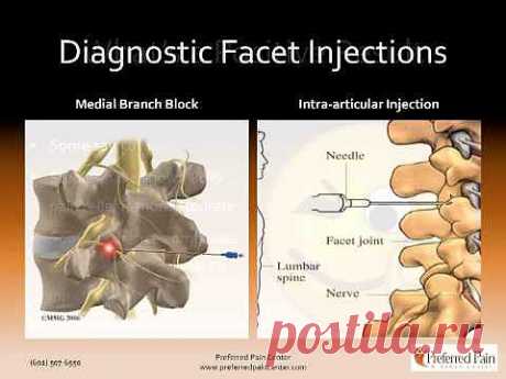 Lumbar Facet Joint Nerve Injections for Treating Chronic Low Back Pain - YouTube