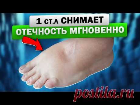 Как старый терапевт спас меня от отёка конечностей! Отек ног - важно