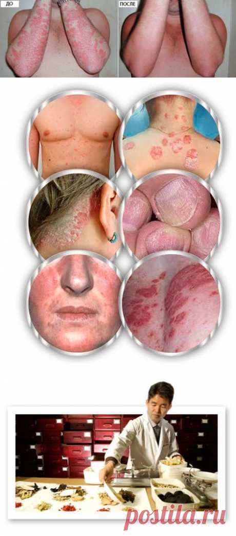 Мазь от псориаза &quot;Король кожи&quot; - псориаз можно вылечить!